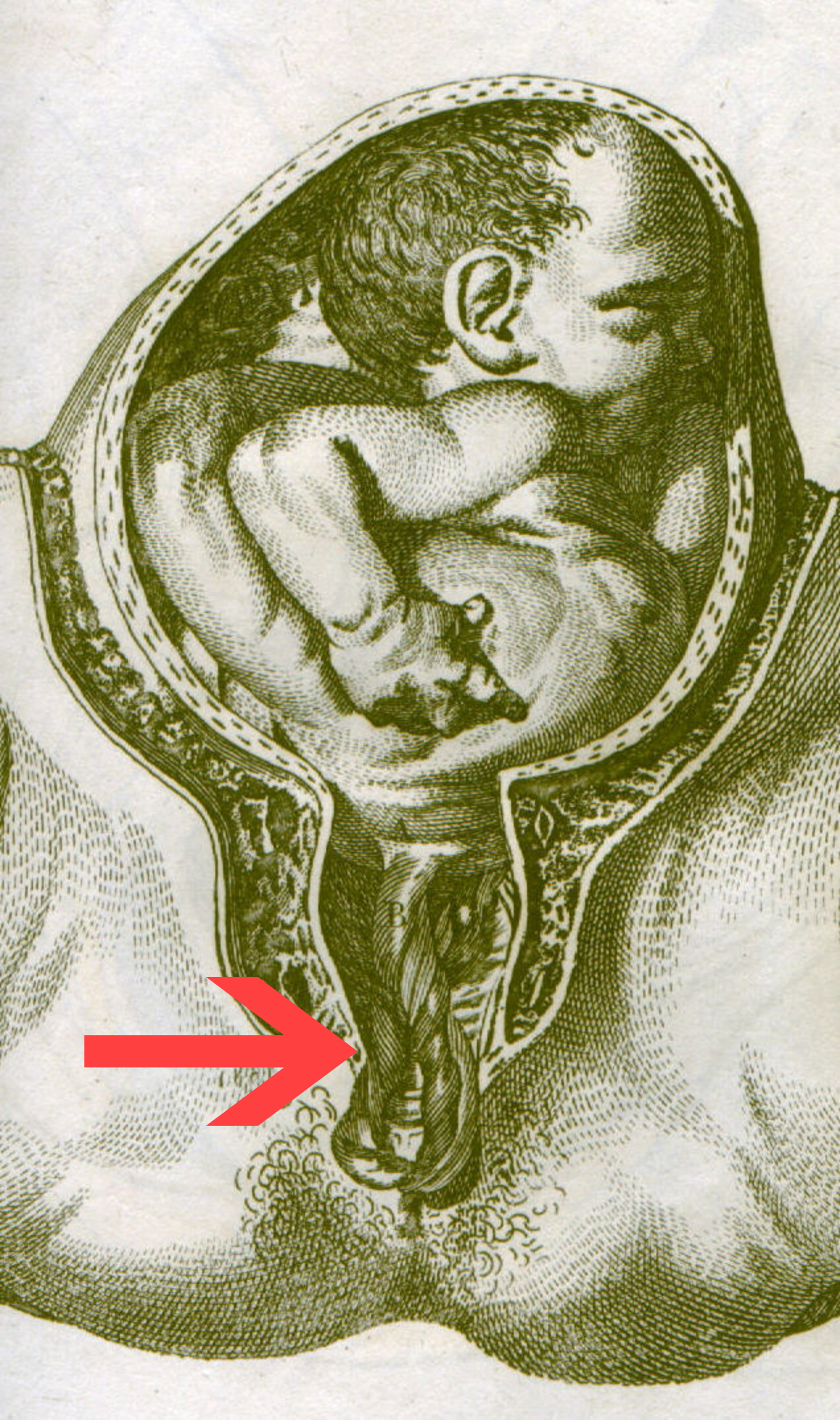 anatomical illustration of umbilical cord prolapse, cord visible below fetal head