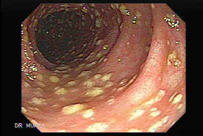 search for pseudomembranous colitis endoscopy image showing yellowish plaques on colon wall