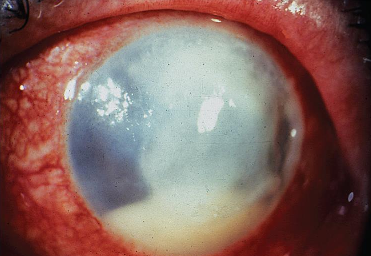 Keratitis Eye
