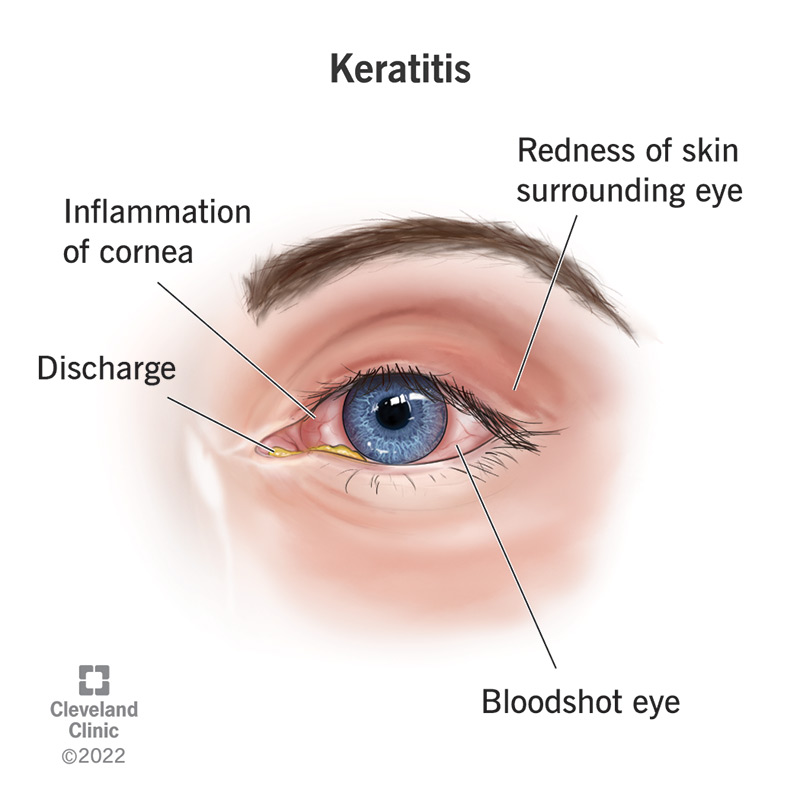 Research Keratitis Eye Eye Cover