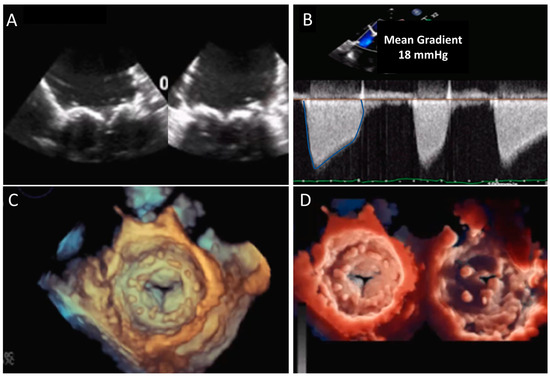 Structural Valve Deterioration Echo