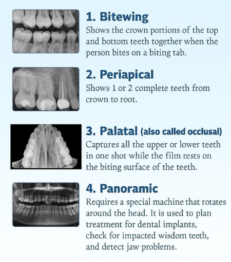 Types of Dental X-Rays
